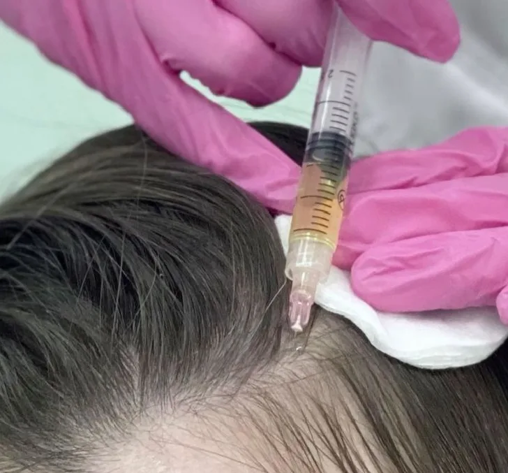 PRP Hair Restoration